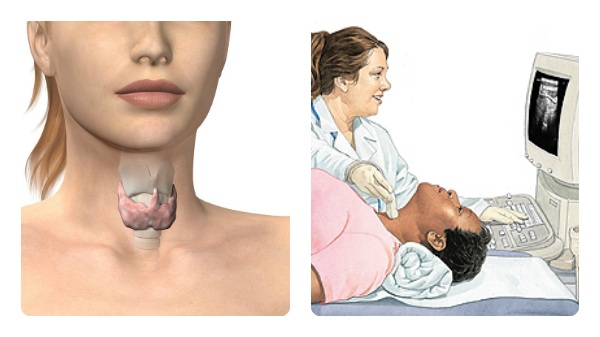 trastorno tiroides