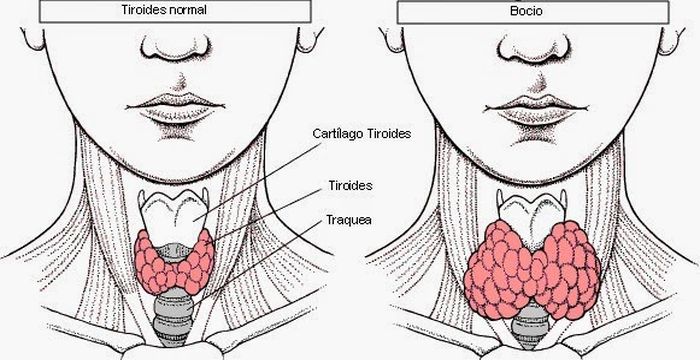 tiroides