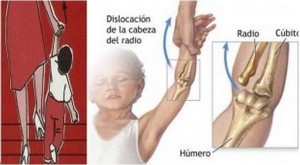 dislocacion de codo