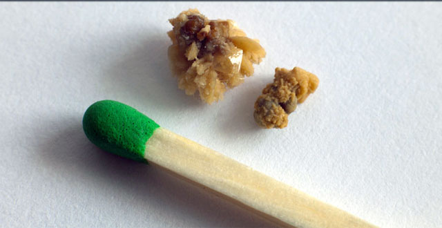 piedras en rinon – Tu Salud Es Vida