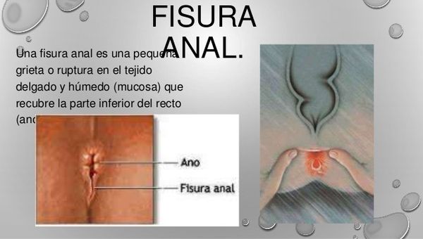 fisura-anal.jpg