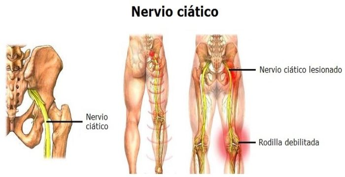 nervio ciatico